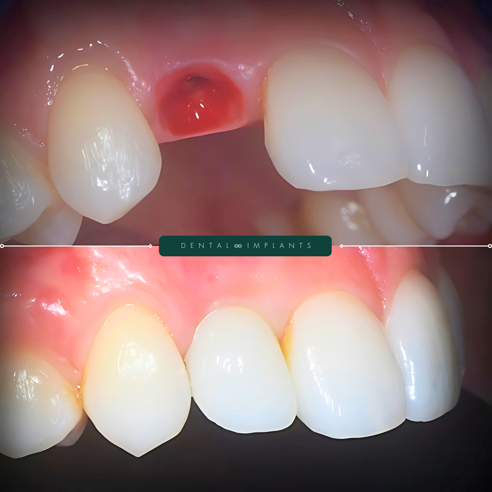 Dental Implants 01 (2)