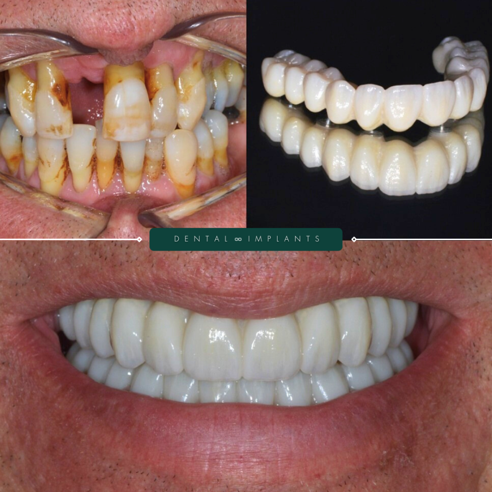 Dental Implants 01 (3)