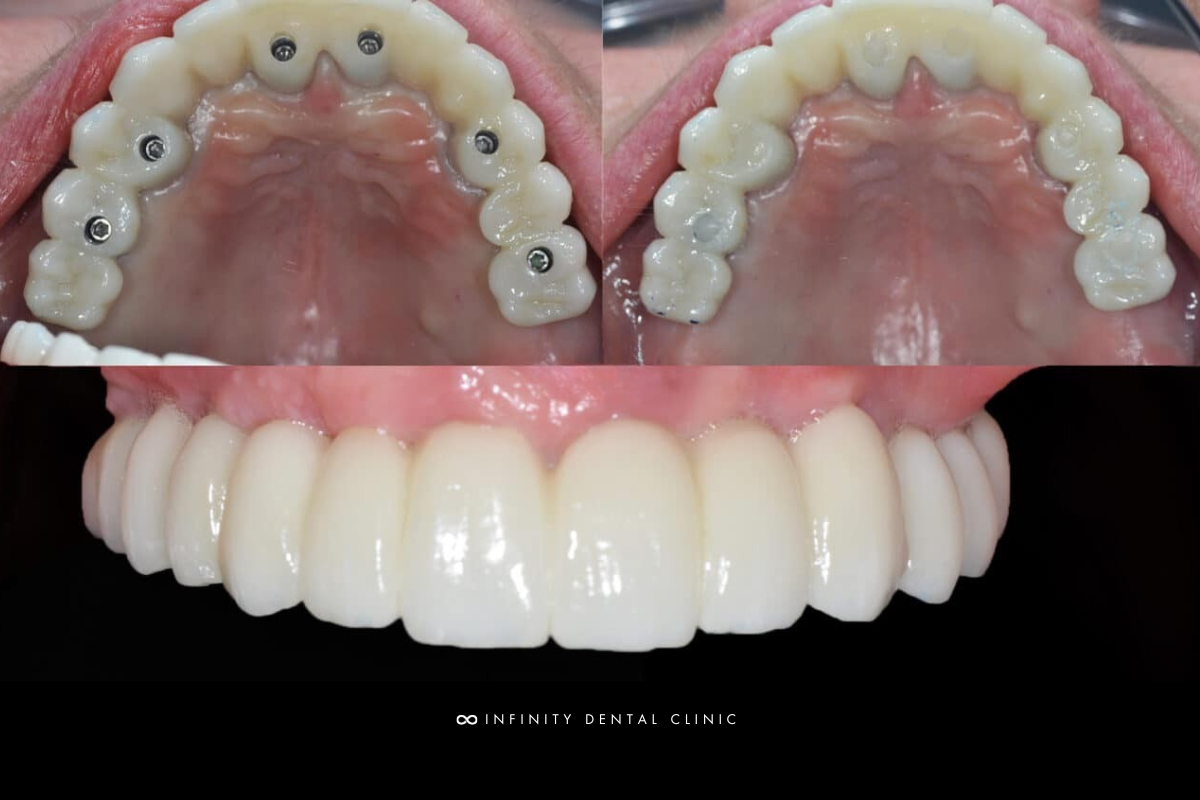 Full Arch Same Day Teeth Banner (3)